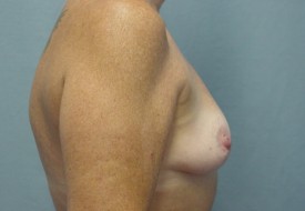 Breast Augmentation Gel
