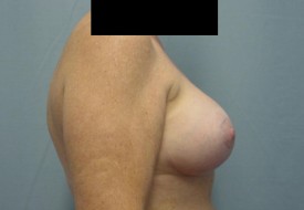 Breast Augmentation Gel