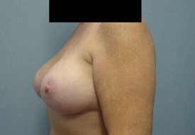 Breast Augmentation Gel