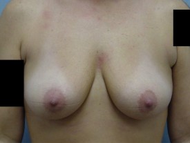 Breast Augmentation Gel