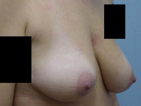 Breast Augmentation Gel