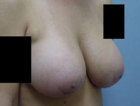 Breast Augmentation Gel