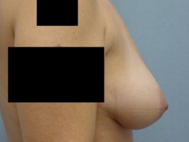Breast Augmentation Gel