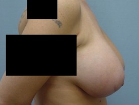 Breast Augmentation Gel