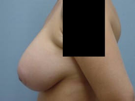 Breast Augmentation Gel