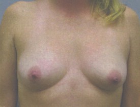 Breast Augmentation Gel