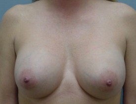 Breast Augmentation Gel