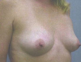 Breast Augmentation Gel