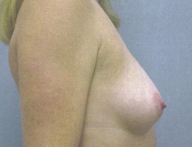 Breast Augmentation Gel