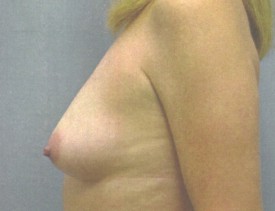 Breast Augmentation Gel