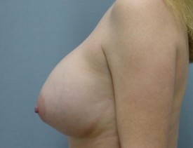 Breast Augmentation Gel