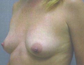 Breast Augmentation Gel