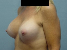 Breast Augmentation Gel