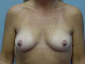 Breast Augmentation Gel