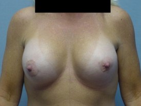 Breast Augmentation Gel