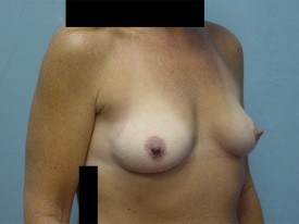 Breast Augmentation Gel