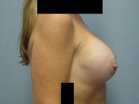 Breast Augmentation Gel