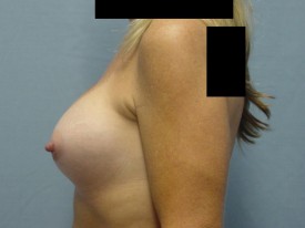 Breast Augmentation Gel