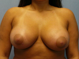 Breast Augmentation Gel