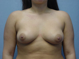 Breast Augmentation Gel