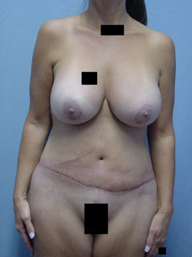 Tummy Tuck-Panniculectomy