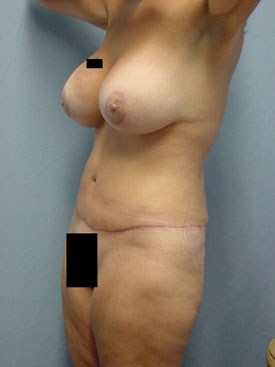 Tummy Tuck-Panniculectomy