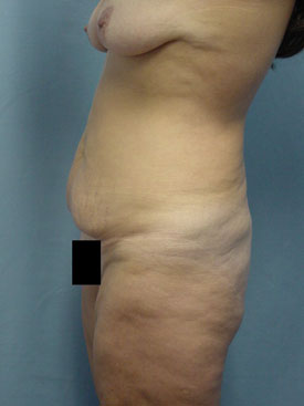 Tummy Tuck-Panniculectomy