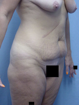 Tummy Tuck-Panniculectomy