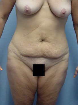 Tummy Tuck-Panniculectomy