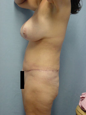 Tummy Tuck-Panniculectomy