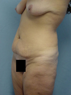Tummy Tuck-Panniculectomy