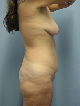 Tummy Tuck-Panniculectomy