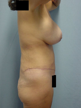 Tummy Tuck-Panniculectomy