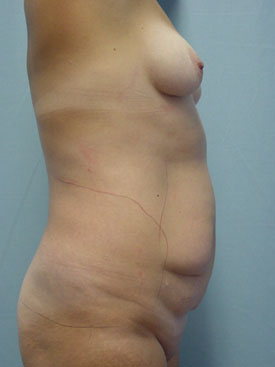 Tummy Tuck-Panniculectomy