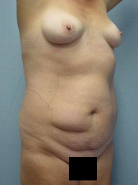 Tummy Tuck-Panniculectomy