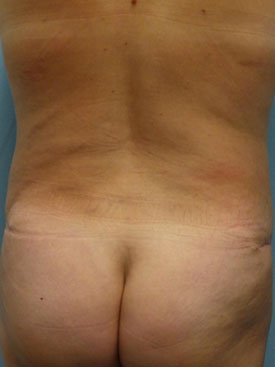 Tummy Tuck-Panniculectomy