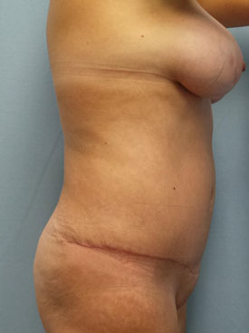 Tummy Tuck-Panniculectomy