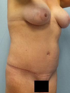 Tummy Tuck-Panniculectomy