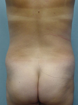 Tummy Tuck-Panniculectomy