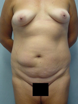 Tummy Tuck-Panniculectomy
