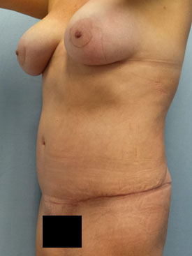 Tummy Tuck-Panniculectomy