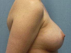 Breast Augmentation Saline