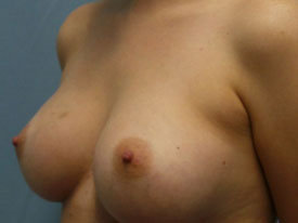 Breast Augmentation Saline