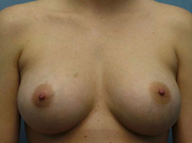 Breast Augmentation Saline