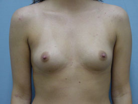 Breast Augmentation Saline