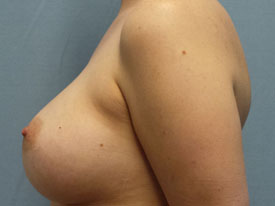 Breast Augmentation Saline