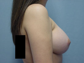 Breast Augmentation Gel