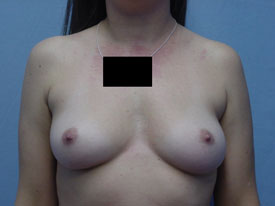 Breast Augmentation Gel