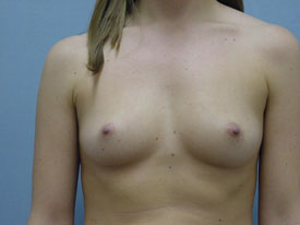 Breast Augmentation Saline