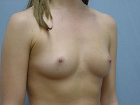 Breast Augmentation Saline